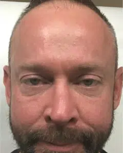 After Image: Botox – Men’s Forehead