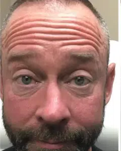 Before Image: Botox – Men’s Forehead