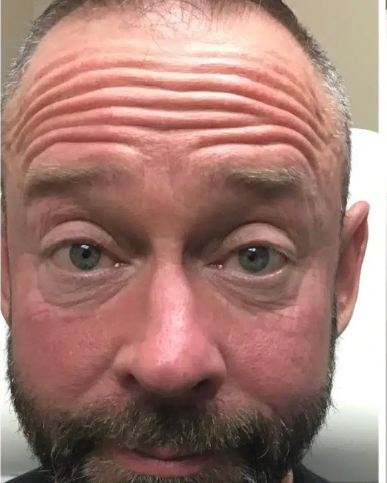 Before Image: Botox – Men’s Forehead - front