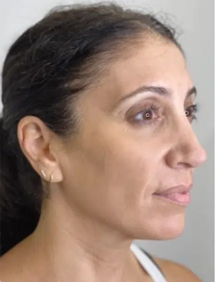 After Image: Microneedling - right-front-oblique