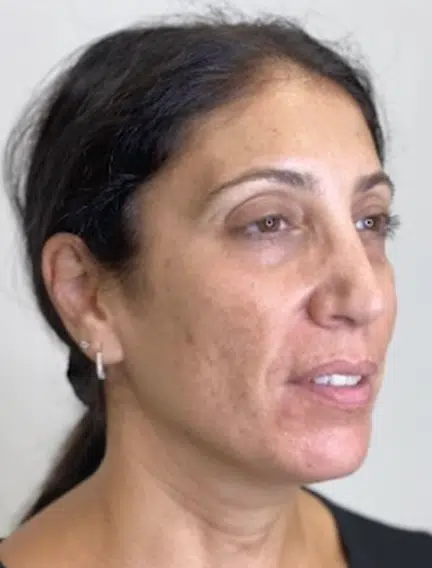 Before Image: Microneedling - right-front-oblique