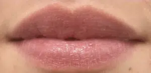 After Image: Restylane Kysse