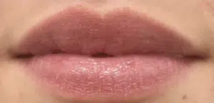 After Image: Restylane Kysse