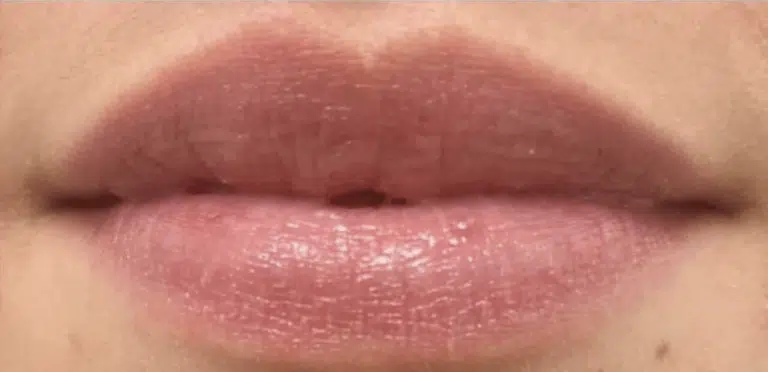 After Image: Restylane Kysse - front