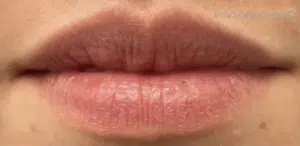 Before Image: Restylane Kysse