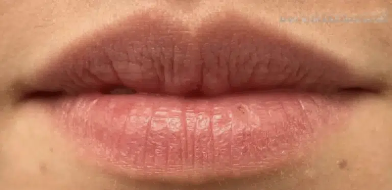 Before Image: Restylane Kysse - front