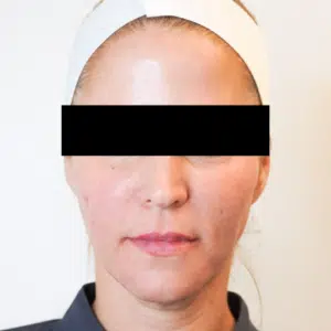 After Image: Sculptra