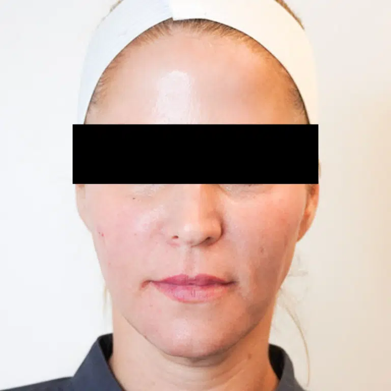 After Image: Sculptra - front