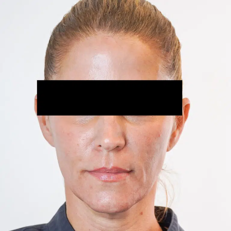 Before Image: Sculptra - front